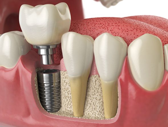 BIACOM®- Composite Material for Implants